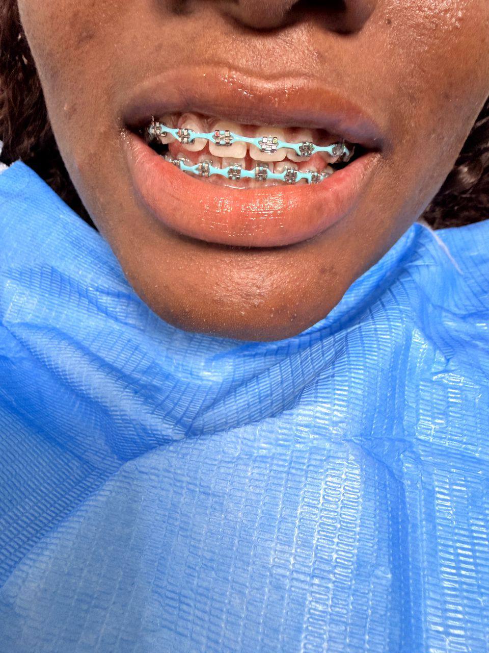 Fashion Braces
